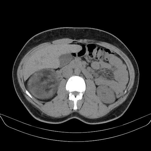 Adrenal myelolipoma - bilateral (Radiopaedia 74805-85810 Axial non-contrast 33).jpg