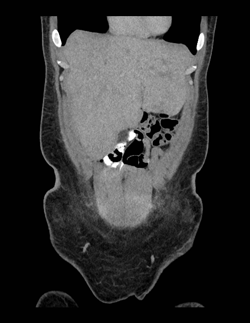Adrenal myelolipoma - bilateral (Radiopaedia 74805-85810 Coronal C+ portal venous phase 220).jpg