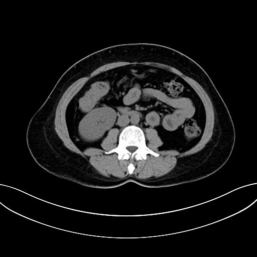 Adrenocortical carcinoma (Radiopaedia 87281-103569 Axial non-contrast 46).jpg