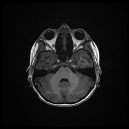 Adrenoleukodystrophy (Radiopaedia 60905-68711 Axial T1 30).jpg