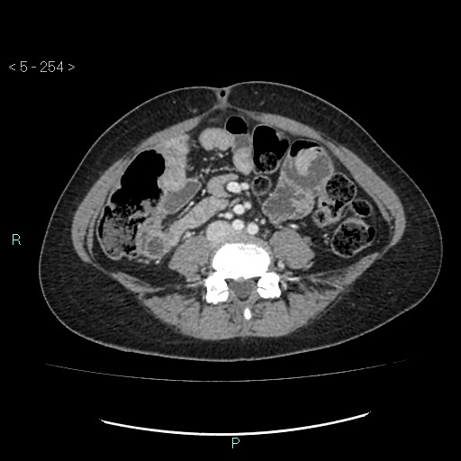 Adult transient intestinal intussusception (Radiopaedia 34853-36310 Axial C+ portal venous phase 54).jpg