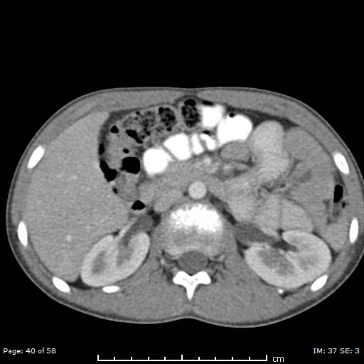 Agenesis of the gallbladder (Radiopaedia 55454-61905 B 40).jpg
