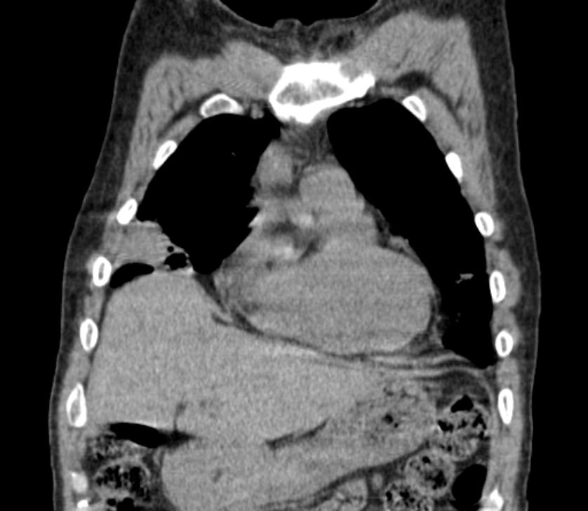 Airway foreign body in adult (Radiopaedia 85907-101779 Coronal liver window 56).jpg