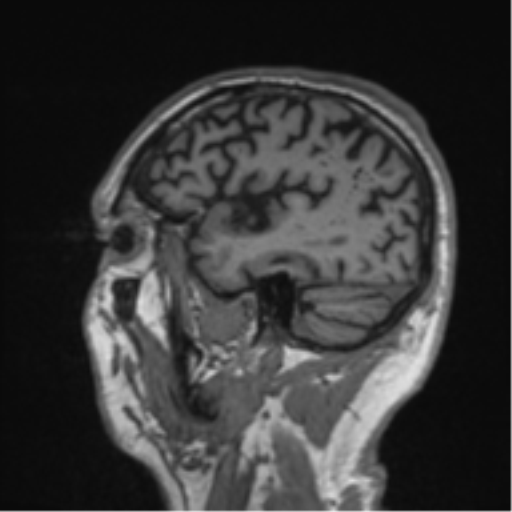 File:Alzheimer's disease- with Gerstmann syndrome and dressing apraxia (Radiopaedia 54882-61150 Sagittal T1 57).png