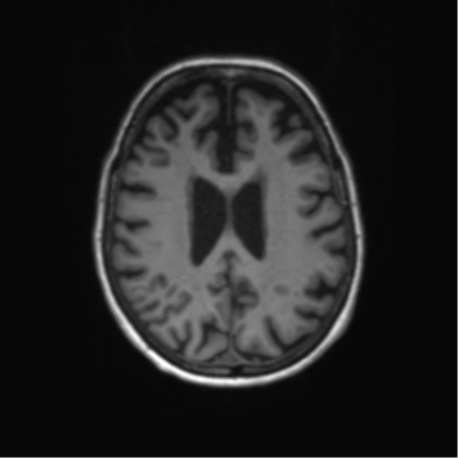 Alzheimer's disease (Radiopaedia 42658-45802 Axial T1 58).png