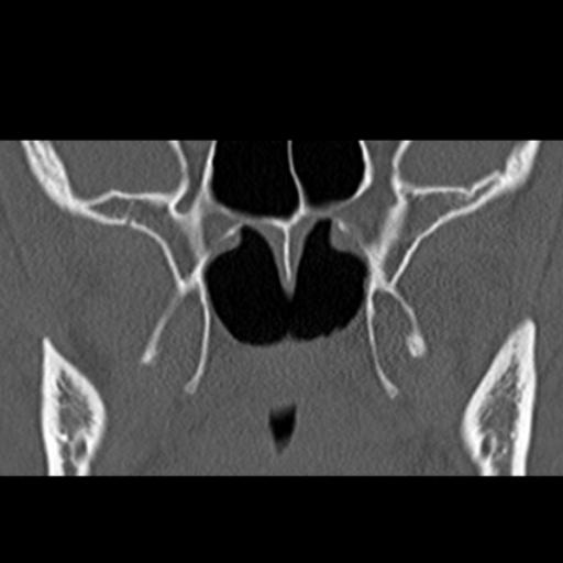 File:Ameloblastic fibro-odontoma (Radiopaedia 18843-18780 B 22).jpg