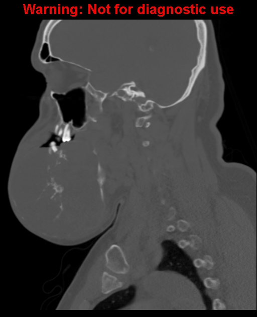 Ameloblastoma (Radiopaedia 33126-34164 Sagittal bone window 31).jpg