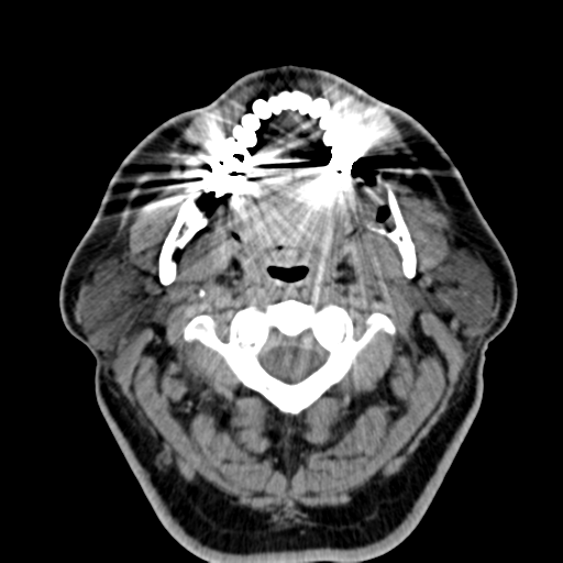 Ameloblastoma (Radiopaedia 38520-40623 Axial non-contrast 27).png