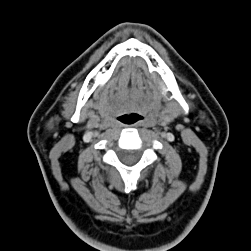 File:Ameloblastoma (Radiopaedia 38520-40623 Axial non-contrast 34).png