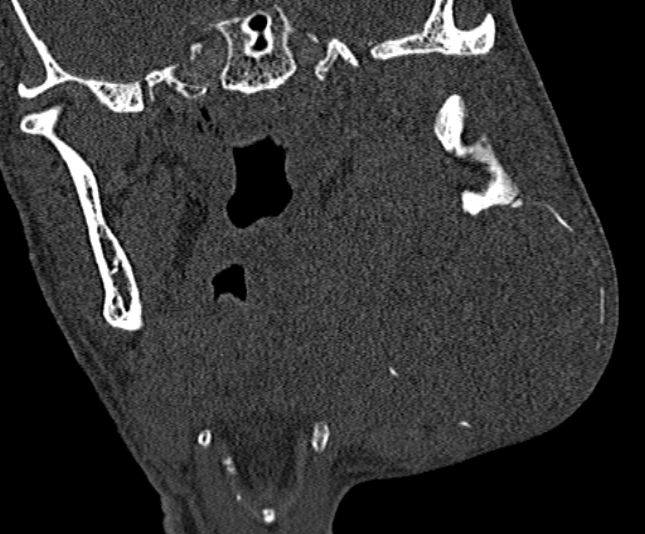 Ameloblastoma (Radiopaedia 51921-57766 Coronal bone window 162).jpg