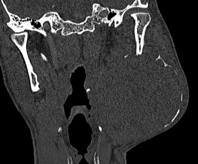 Ameloblastoma (Radiopaedia 51921-57766 Coronal bone window 182).jpg