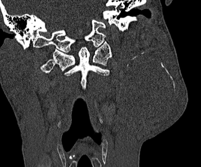 Ameloblastoma (Radiopaedia 51921-57766 Coronal bone window 210).jpg