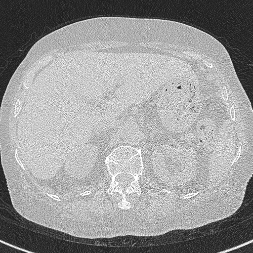 Amiodarone-induced pulmonary fibrosis (Radiopaedia 82355-96460 Axial lung window 69).jpg