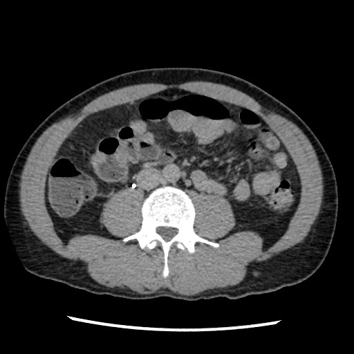 Amoebic liver abscesses (Radiopaedia 55536-62009 Axial C+ delayed 51).jpg