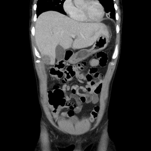 Amoebic liver abscesses (Radiopaedia 55536-62009 B 17).jpg