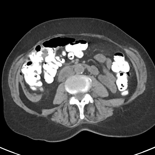 File:Ampullary adenocarcinoma (Radiopaedia 34013-35237 Axial non-contrast 32).png