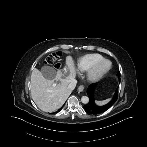 File:Ampullary adenocarcinoma (Radiopaedia 59373-66734 C 31).jpg