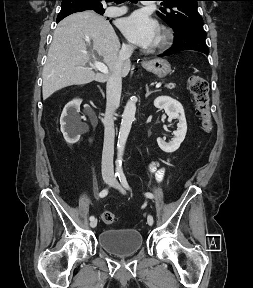 Ampullary adenocarcinoma (Radiopaedia 59373-66734 D 56).jpg