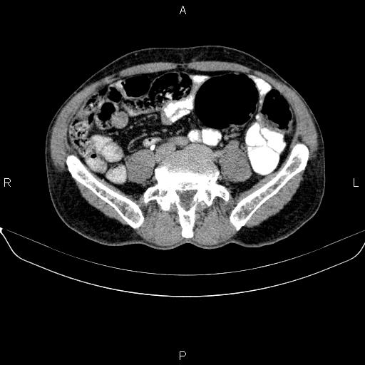 Ampullary adenocarcinoma (Radiopaedia 86093-102032 Axial C+ delayed 71).jpg