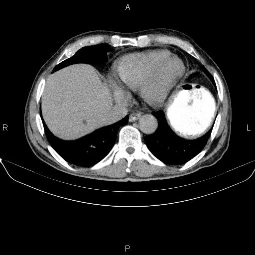 Ampullary adenocarcinoma (Radiopaedia 86093-102032 Axial C+ delayed 9).jpg