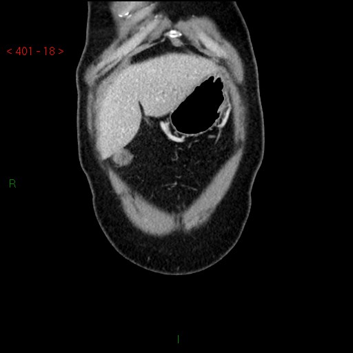 Ampullary carcinoma (Radiopaedia 56396-63056 E 17).jpg