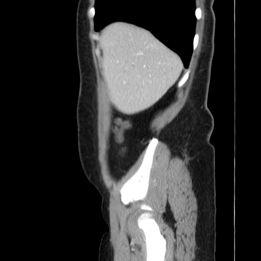 Ampullary tumor (Radiopaedia 22787-22816 D 10).jpg