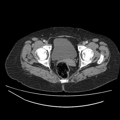 Ampullary tumor (Radiopaedia 60333-67998 A 87).jpg