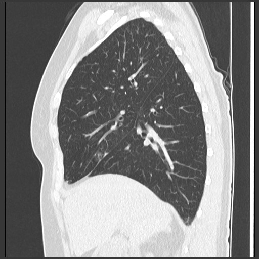 Amyloidosis - bronchial and diffuse nodular pulmonary involvement (Radiopaedia 60156-67744 F 19).jpg
