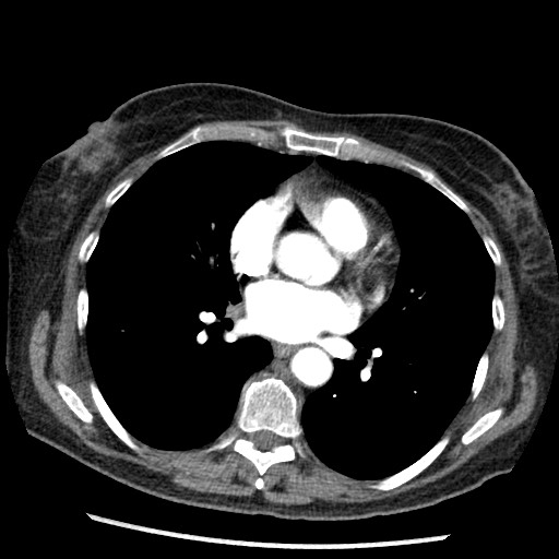 Amyloidosis - bronchial and diffuse nodular pulmonary involvement (Radiopaedia 60156-67745 A 30).jpg