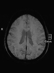 File:Amyotrophic lateral sclerosis (Radiopaedia 70821-81017 Axial SWI minIP 32).jpg