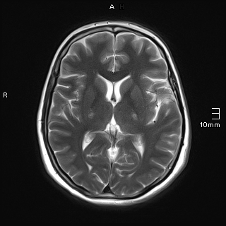 File:Amyotrophic lateral sclerosis (Radiopaedia 70821-81017 Axial T2 14).jpg
