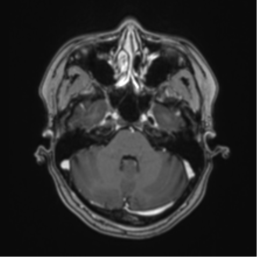 Anaplastic astroblastoma (Radiopaedia 55666-62194 Axial T1 C+ 19).png