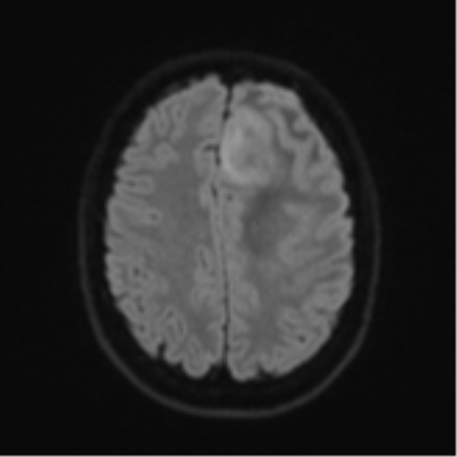 Anaplastic astrocytoma (Radiopaedia 57768-64731 Axial DWI 49).png