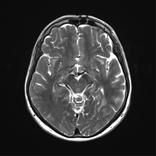 File:Anaplastic astrocytoma (Radiopaedia 86943-103160 Axial T2 18).png