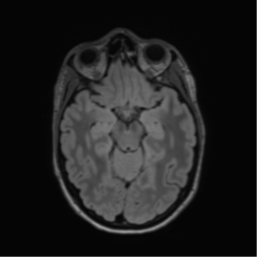File:Anaplastic astrocytoma IDH mutant (Radiopaedia 50046-55341 Axial FLAIR 20).png