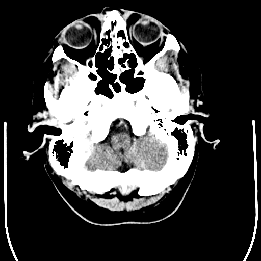 File:Anaplastic meningioma with recurrence (Radiopaedia 34452-35781 Axial Contrast 5).png