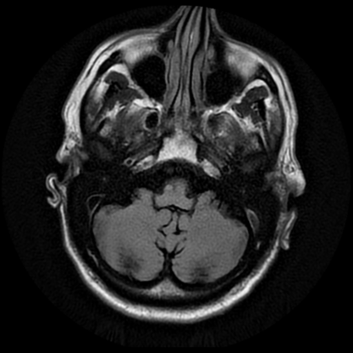 File:Anaplastic meningioma with recurrence (Radiopaedia 34452-35790 Axial T2 FLAIR 4).png