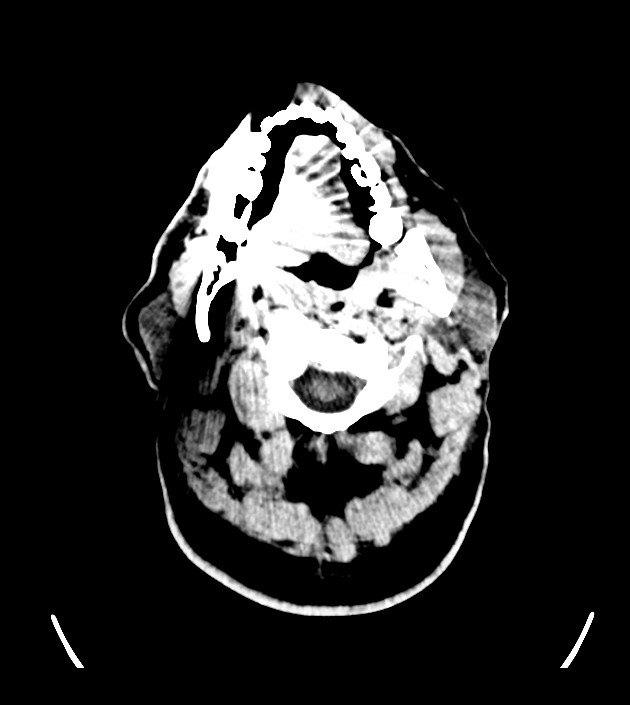 Anaplastic oligodendroglioma (Radiopaedia 79571-92755 Axial non-contrast 1).jpg