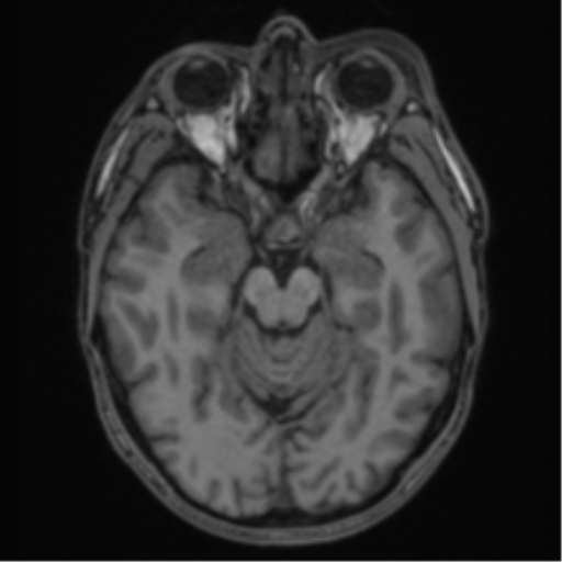 Anaplastic oligodendroglioma with skull fracture (Radiopaedia 74831-85845 Axial T1 22).png
