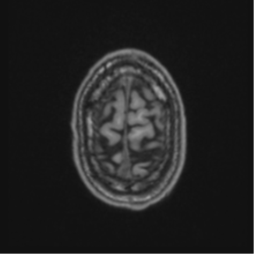 Anaplastic oligodendroglioma with skull fracture (Radiopaedia 74831-85845 Axial T1 61).png