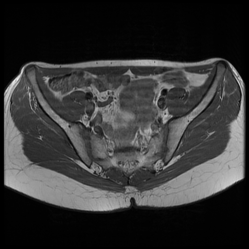 File:Androgen insensitivity syndrome (Radiopaedia 38585-40727 Axial T1 7).jpg