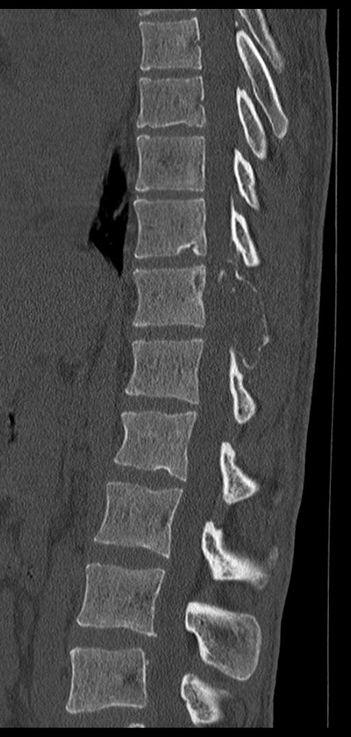 Aneurysmal bone cyst T11 (Radiopaedia 29294-29721 Sagittal bone window 42).jpg