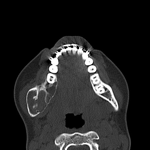 Aneurysmal bone cyst of the mandible (Radiopaedia 43280-46601 Axial bone window 28).jpg