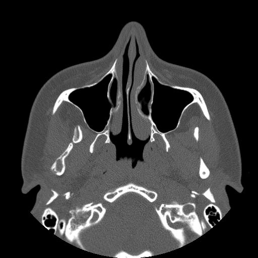 Aneurysmal bone cyst of the mandible (Radiopaedia 43280-46823 Axial bone window 123).jpg