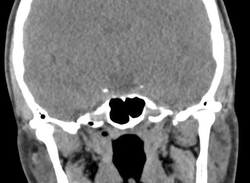 Angular dermoid cyst (Radiopaedia 88967-105790 Coronal non-contrast 64).jpg