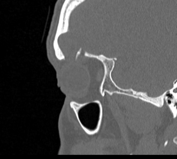 Angular epidermoid cyst (Radiopaedia 46908-51439 Sagittal bone window 78).png