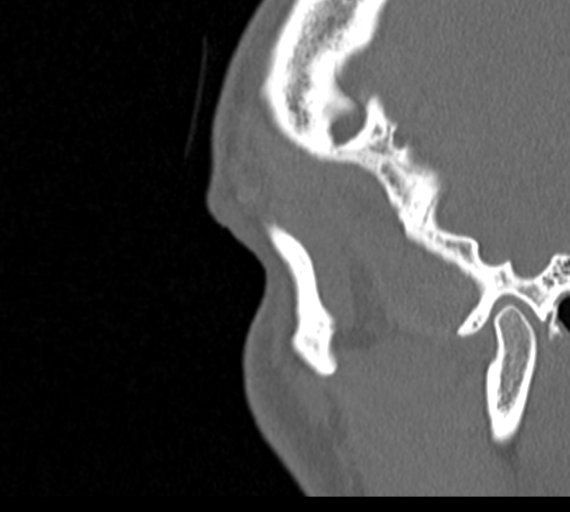 Angular epidermoid cyst (Radiopaedia 46908-51439 Sagittal bone window 97).png