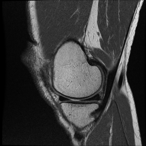 File:Anomalous insertion of the medial meniscus (Radiopaedia 77559-89721 Sagittal PD 41).jpg
