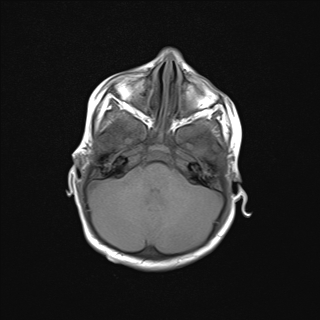 File:Anoxic brain injury (Radiopaedia 79165-92139 Axial T1 7).jpg