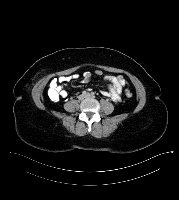 Anterior abdominal wall CSF pseudocyst (CSFoma) (Radiopaedia 79453-92571 A 59).jpg
